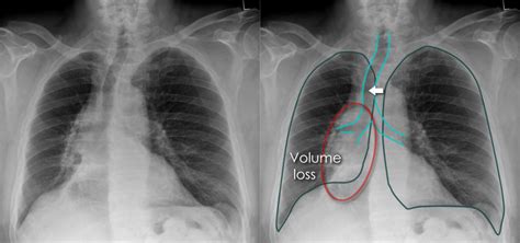 Chest X Ray Airways And Lung Collapse Right Lower Lobe Collapse