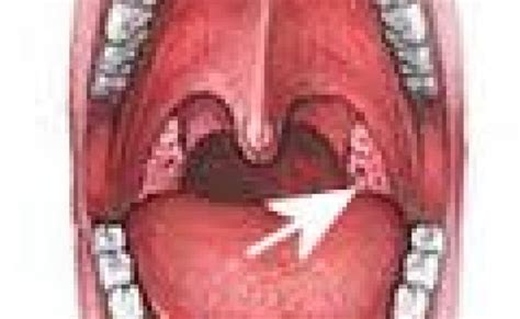 witte plekjes  mond  keel oorzaken en wat te doen mens en otosection