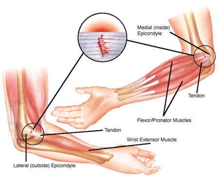 outer elbow pain  weight lifting  ways  fix