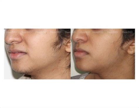 pcos hair growth on chin treated by laser hair removal