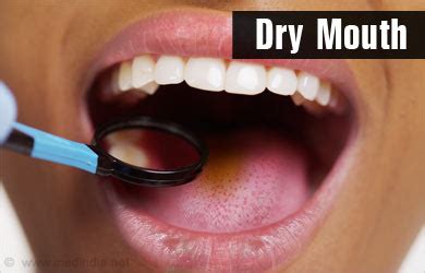 dry mouth  symptoms diagnosis treatment prevention