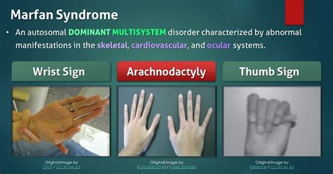 Marfan Syndrome What To Know