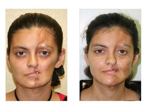 Facial Implants Sarasota Surgical Arts