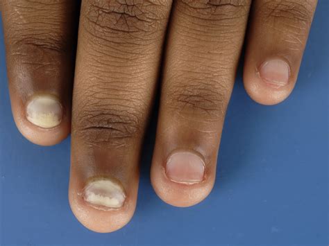 witte vlekken nagels vlekken nagels vlek aha betekenen nagelstudio