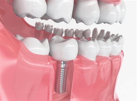 guide    types  dental implants