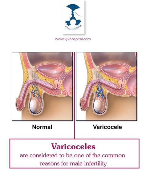 varicocele in 2020 male infertility treatment infertility