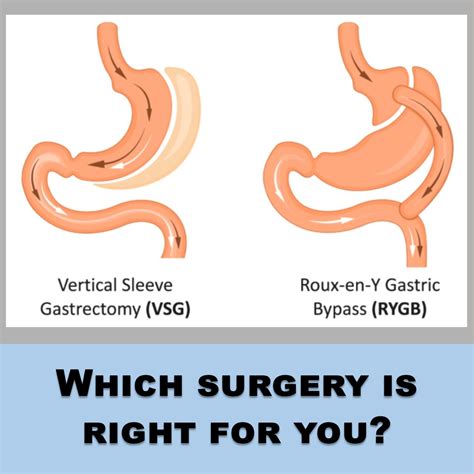 gastric bypass  gastric sleeve surgery  weight loss procedure
