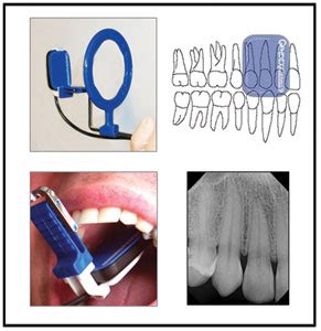 digital  ray sensors placement  optimum images dentalcomparecom
