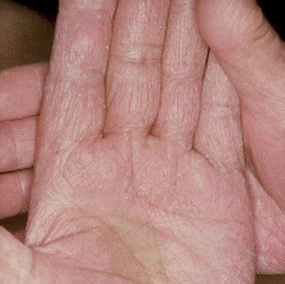 medical pictures info fungal skin infection