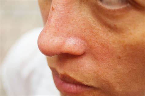 rid  red   side   nose healthy living