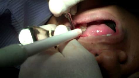 best oral surgery wisdom tooth extraction youtube