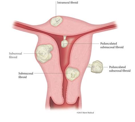 uterine fibroid embolization ufe radiology associates of hartford