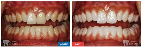 9 cách làm trắng răng bị ố vàng đơn giản tại nhà chỉ trong