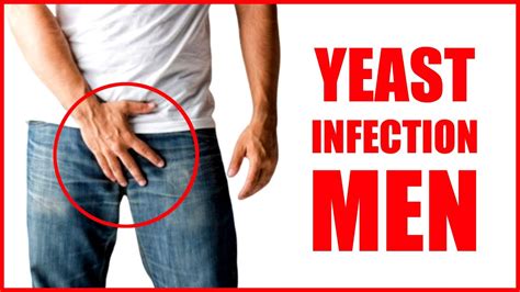 Yeast Infection In Men – Male Yeast Infection Symptoms Thrush Fungal