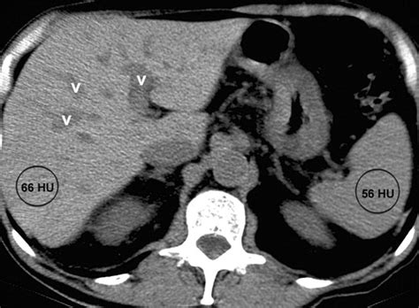 Fatty Liver Imaging Patterns And Pitfalls Radiographics