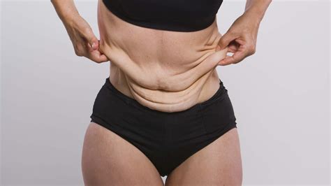 Extreme Weight Loss Women Get Real About Their Loose Skin After Weight