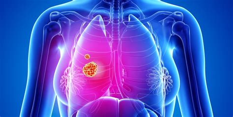 9 signs and symptoms of lung cancer according to doctors