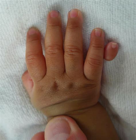 extra digits    treatment congenital hand  arm differences