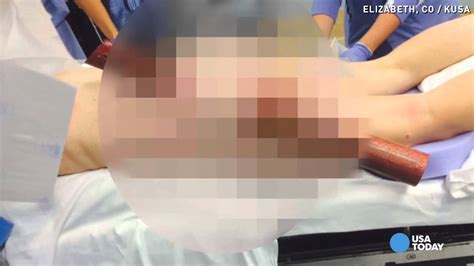 woman impaled in buttocks after texting while driving youtube