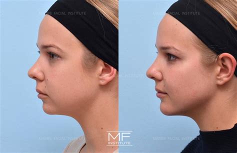How To Get Defined High Cheekbones With Cheek Filler In San Francisco