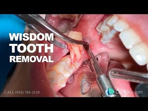 wisdom teeth removal   expect  teethwalls