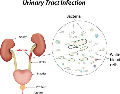 elderberry tea    answer  urinary tract infections