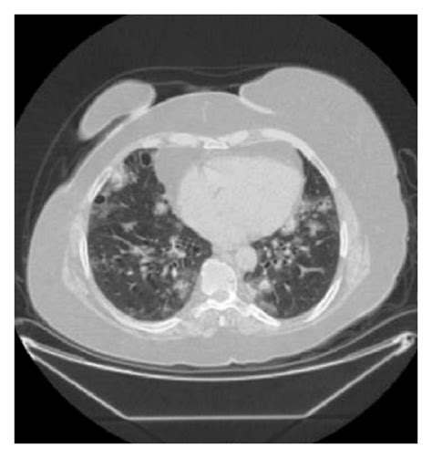 Multiple Calcified Nodules Air Cysts In Both Lungs And Download