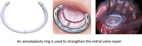 Mitral Valve Repair Surgery What You Need To Know • Myheart