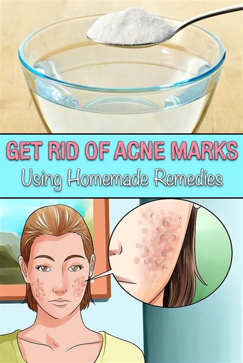 get rid of acne marks using homemade remedies simple tips for you