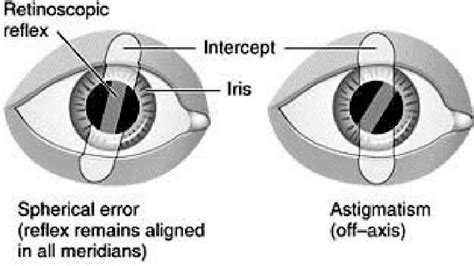 retinoscopy youtube
