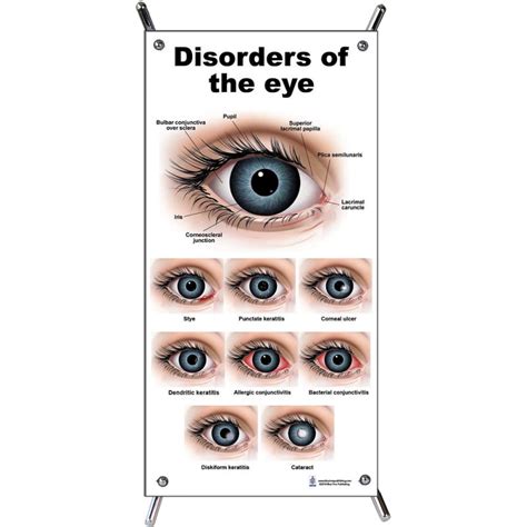 Eye Disorders Small Poster