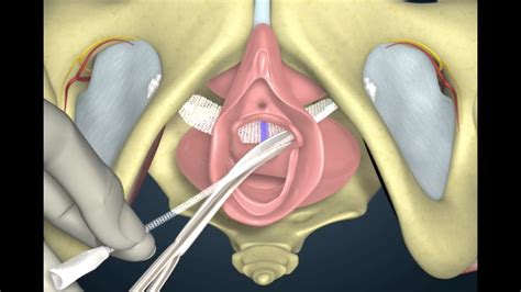 cr bard ajust™ vaginal bladder sling youtube