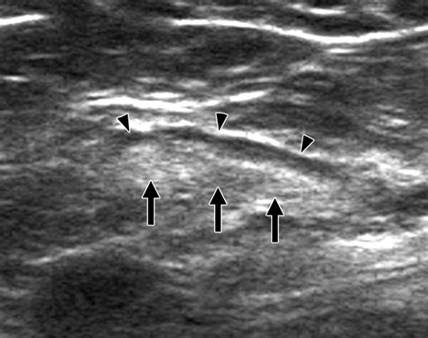 Us Guided Core Needle Biopsy Of Axillary Lymph Nodes In Patients With
