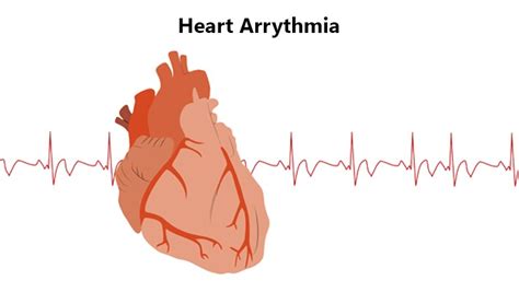 Heart Arrhythmia Symptoms Causes And Prevention Robustposts