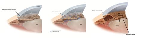 glaucoma information occludable angle glaucoma information