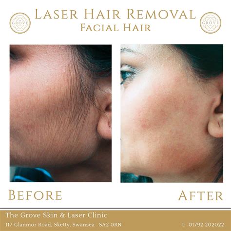 laser hair removal swansea laser treatment hair removal