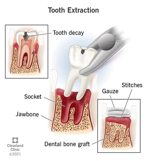 tooth extraction procedure aftercare recovery