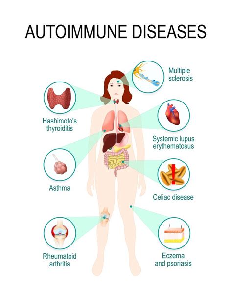 immune system diseases types symptoms prevention stdgov blog
