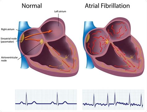 Cardiology 101 – Atrial Fibrillation Usmle Causes Symptoms