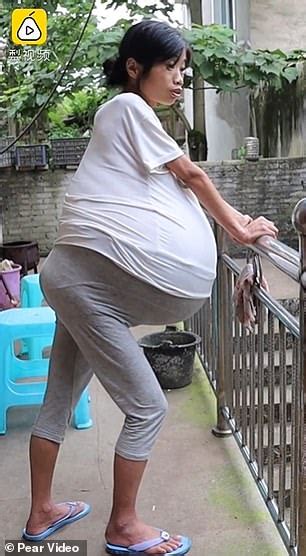chinese woman s belly grows to 44lbs due to mystery condition daily