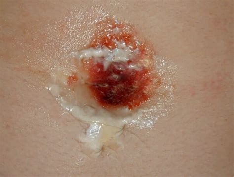 Belly Button Rash Causes Symptoms And Treatments
