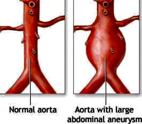 aortic aneurysms   patients     abdominal aortic