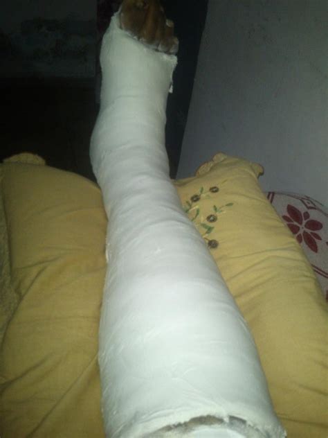 blogger broken leg