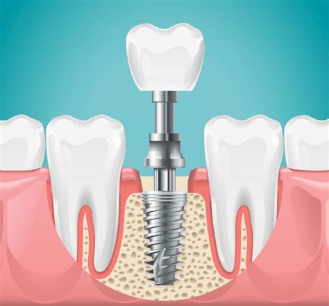 implants cornerstone dental