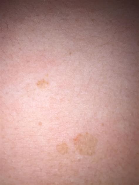 red spots  skin vrogueco
