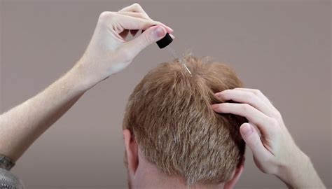 What To Know About Happy Head The Latest Hair Loss Company – Spy