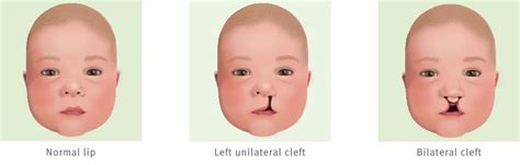cleft lip childrens health queensland