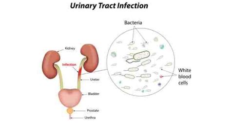 Urinary Tract Infection Treatment And Symptoms Urinary