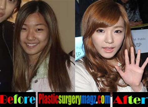 Tiffany Snsd Plastic Surgery Before And After Plastic