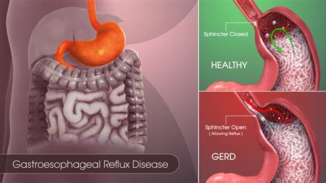 gastroesophageal reflux disease gerd symptoms  risks treatment
